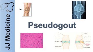 Pseudogout  Pathophysiology Symptoms and Treatment [upl. by Laine]