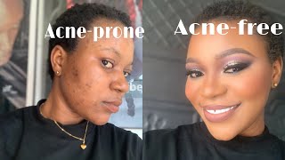 I WENT FROM ACNEPRONE TO ACNEFREE FACE USING MAKEUP APPLICATION [upl. by Aihpledalihp]