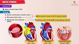 Aortic Stenosis  Causes  Symptoms  Pathology  Diagnosis and Treatment [upl. by Ellehcal207]