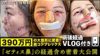 【整形】全顔美容整形の一部始終を密着大公開  ダウンタイム中の経過映像も特別公開【くま取り・脂肪吸引・糸リフト・鼻整形・脂肪注入】ゼティス鼻 美容整形 zetithbeautyclinic [upl. by Thurlow]