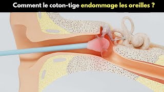 Comment le cotontige endommage les oreilles   Les cotonstiges sontils nocifs [upl. by Aneres]