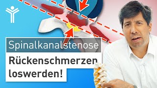 Rückenschmerzen durch Spinalkanalstenose richtig behandeln  Wann operieren [upl. by Hulen]