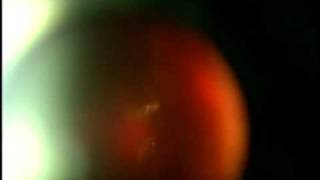 An Amazing Laser Eye Floater case by Scott Geller MD Florida USA tel 2392758222 [upl. by Erinna]