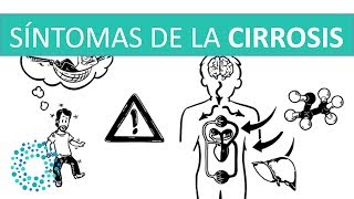 CIRROSIS SINTOMAS iniciales y finales [upl. by Curren243]