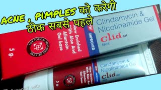 Clid gel for acne uses in hindi  clindamycin amp Nicotinamide gel review in hindi [upl. by Charlotta]