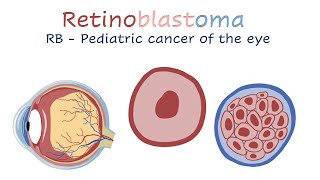 Retinoblastoma [upl. by Allimac422]