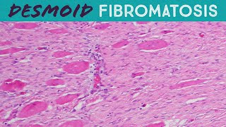 Desmoid Tumor Fibromatosis explained in 5 minutes pathology usmle FAP familial adenomatosis coli [upl. by Westfahl]