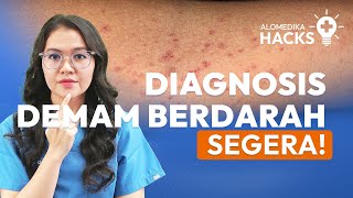 Tes Rumpel Leede Tourniquet Test untuk Demam Berdarah Dengue [upl. by Jarnagin613]