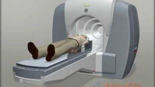 Neurology animation  Gamma Knife Surgery [upl. by Schwartz]