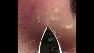 Blackhead Removal With Tweezer 1 Hour [upl. by Artek467]