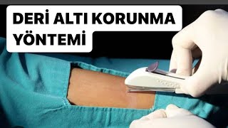 NEXPLANON DERİALTI DOGUM KONTROL İMPLANT doğumkontrolhapı korunmayöntemleri derialtıimplant [upl. by Aneehsram]