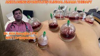 ANKYLOSING SPONDYLITIS CLINICAL HIJAMA THERAPY [upl. by Wira]