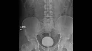 CASE 395 intravenous pyelography IVP left renal agenesis [upl. by Ahsiem]