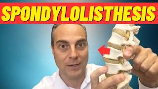 What Is Spondylolisthesis What Is Anterolisthesis Dr Walter Salubro Chiropractor in Vaughan [upl. by Scarrow637]