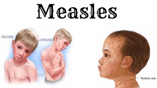 Everything about MEASLES in detail and simple [upl. by Neleh]