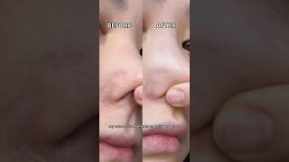 Clogged pores blackheads shorts short music edm fyp viral tiktok trendingshorts beauty diy [upl. by Thurlow]