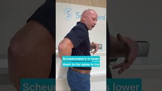 Early treatment of Scheuermanns hyperkyphosis with KyphoBrace is crucial SpineHealth KyphoBrace [upl. by Westphal]