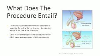 Vasectomy Reversal [upl. by Erbma]