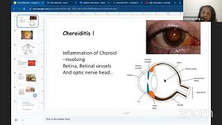 Homoeopathy for Choroiditis [upl. by Shiller478]