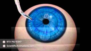 Conductive Keratoplasty Procedure  Ophthalmology Animation [upl. by Couhp]