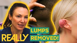 DIY How to Get Rid of Your Keloid Using Only TWO Ingredients [upl. by Servetnick277]