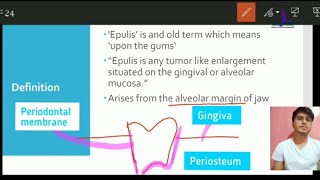 What is Epulis  EASY UNDERSTANDING OF EPULIS  Dentistry  Milestone [upl. by Aseeral]