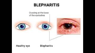 Blepharitis Definition of blepharitis Causes of blepharitis✨ [upl. by Dianne396]