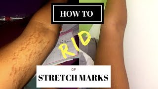 HOW TO GET RID OF STRETCH MARKS amp SCARS FAST  RealWednesdays [upl. by Elamaj405]