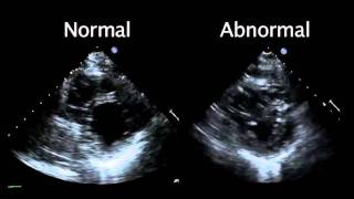 Echocardiogram from the Patient Compared with That from a Normal Control  NEJM [upl. by Htenaj]