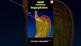 GERD symptoms in hindi  gerd full form  shorts [upl. by Aivila]