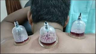 Surprising truths about cupping therapy for Neck pain [upl. by Yornek852]