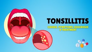 Tonsillitis – Causes Signs and Symptoms Diagnosis amp Treatment [upl. by Terag977]