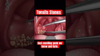 TONSILS STONES TONSILLITIS [upl. by Yesllek]