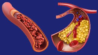 Dyslipidemia Causes And Symptoms [upl. by Drarehs]