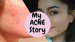 My Acne story Accutane PCOS retinoids I The Junior Doctor [upl. by Tasia]