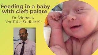 Feeding in babies with cleft lip and palate Dr Sridhar K [upl. by Inahteb464]