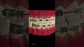 How Does Dental Braces Work [upl. by Aonehc270]