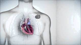 icd implantable cardioverter defibrillator  worlds single chamber ICD wwwpacemakercomhk [upl. by Macintyre]