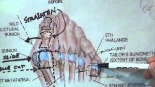 How Do You Fix a Bunionette Tailors Bunion  Dr Moore Explains [upl. by Bolling]