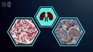 What is atypical haemolytic uraemic syndrome aHUS [upl. by Liauqram]