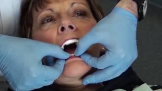 How to insert Sleep apnea device in the patient’s mouth [upl. by Alrac]