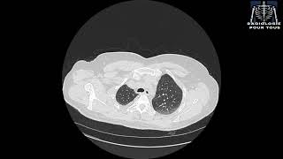 SCANNER THORACIQUE  Pleurésie bilatérale déjà traité pour TBK pulmonaire [upl. by Atinyl290]