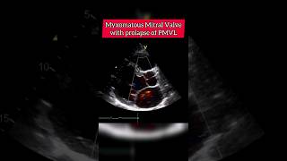 Myxomatous Mitral Valve with Prolapse of PMVL echocardiography heart [upl. by Aalst]