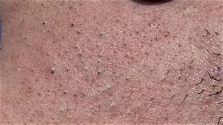 BLACKHEADS EXTRACTIONS on Happy 26 [upl. by Pandolfi]