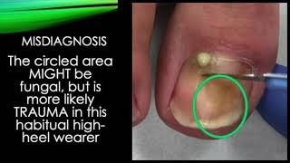 Video  septic toe nail treated by trephining [upl. by Sioux]