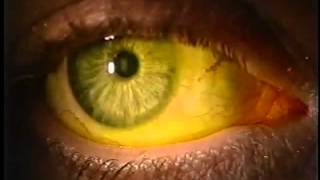 Instilling Fluorescein Dye in the Eye [upl. by Pamella844]