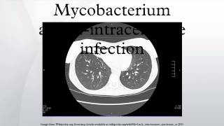 Mycobacterium aviumintracellulare infection [upl. by Gnuhp]