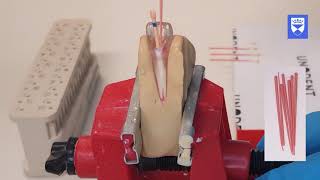 Endodontic treatment of the single rooted tooth Part 6 Obturation [upl. by Eelyk]