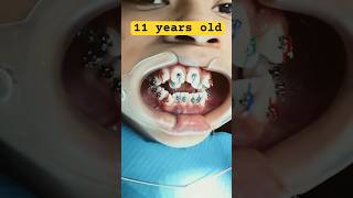 BRACES Orthodontics In Progress 3 years [upl. by Anil719]