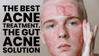 The best ACNE treatment Part 1 The gut acne link [upl. by Sateia]